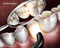 approvisionnement dentaire dentaire lumière de polymérisation menée avec du CE