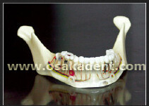 Forme dentaire du modèle d'enseignement d'implant dentaire