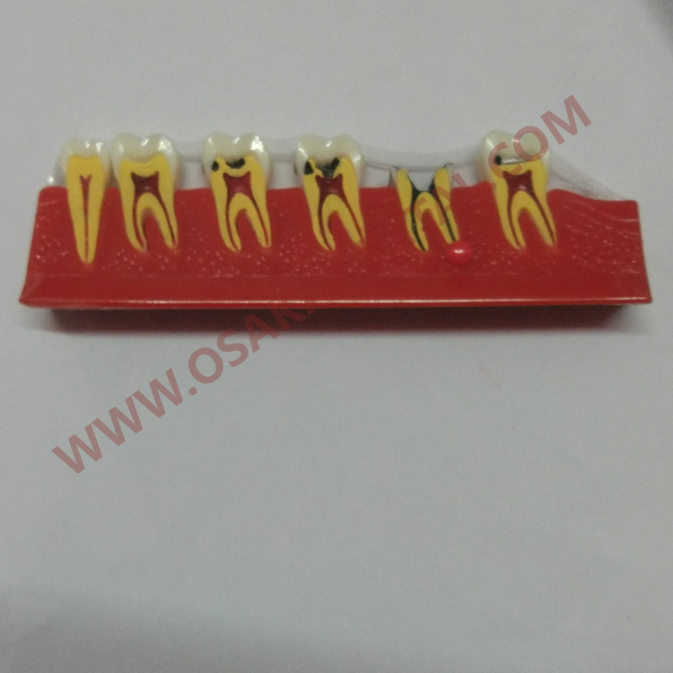 OSA-4011A Caries Forme des dents du modèle d'enseignement dentaire / modèle dentaire / pièce à main dentaire / équipement dentaire