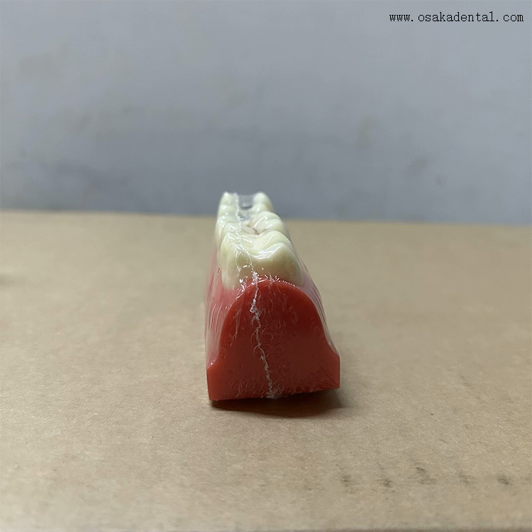 Modèle de démonstration de scellant pour fosses et fissures dentaires 