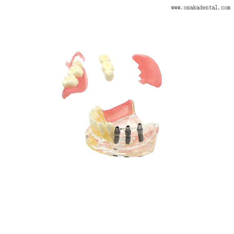 Modèle de comparaison de restauration d’implants dentaires pour l’enseignement des dentistes