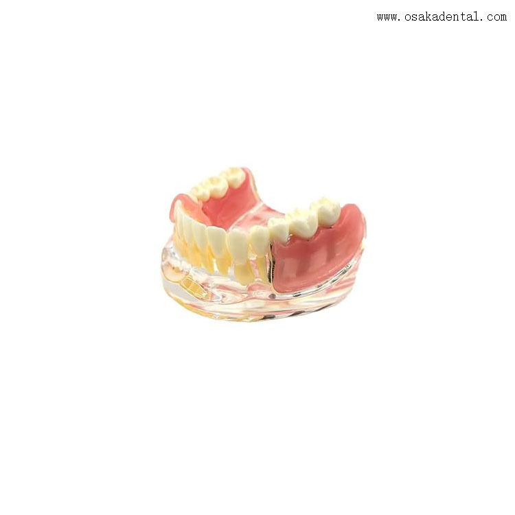 Modèle de comparaison de restauration d’implants dentaires pour l’enseignement des dentistes