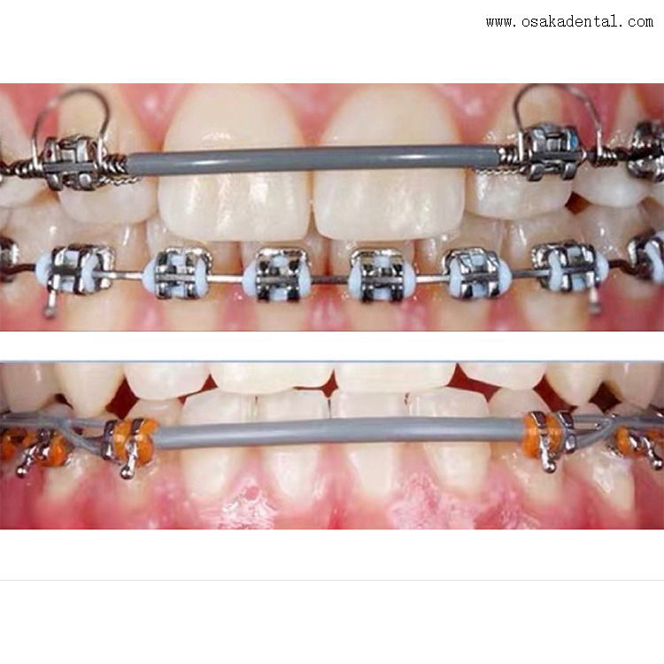 Manchon pour arc orthodontique dentaire