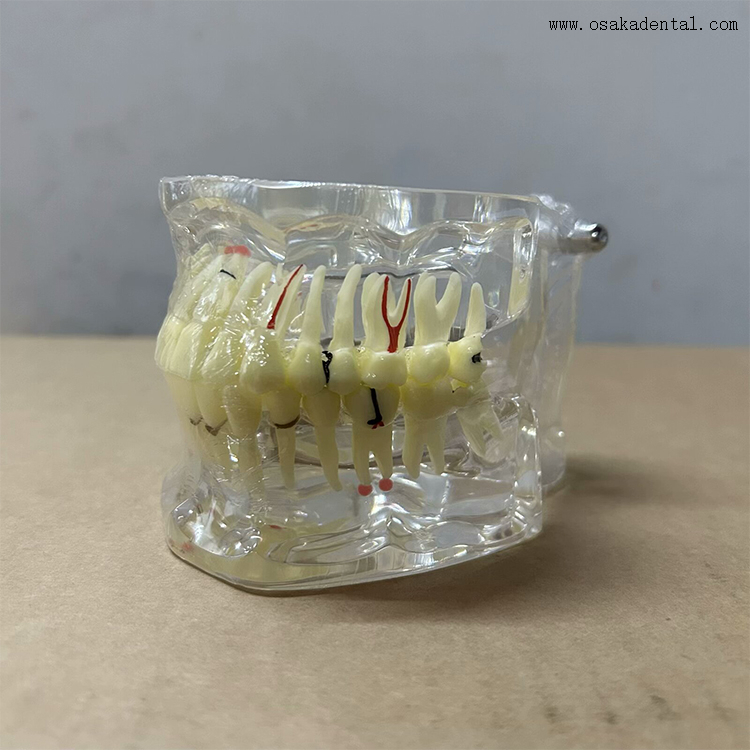 Modèle de pathologie dentaire pour l'enseignement des dentistes