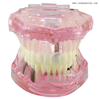 Modèle d'implant dentaire pour l'enseignement des dentistes