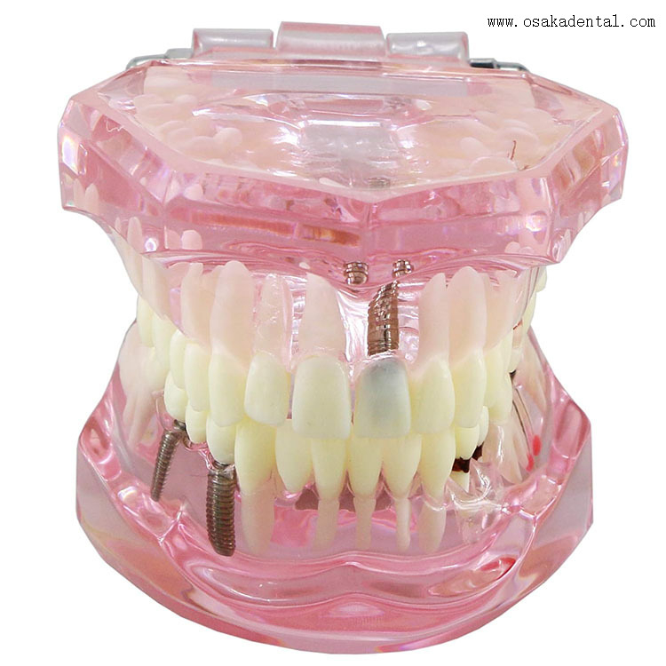 Modèle d'implant dentaire pour l'enseignement des dentistes