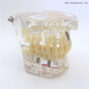 Modèle d'implant dentaire de dents pathologiques pour la pratique